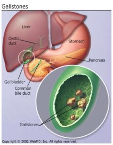 basics_gallstones_padhamhealthnews