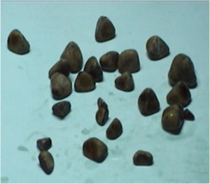 gallladder stones-padham health news