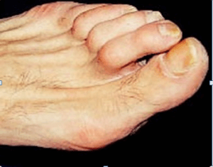 diabetic-foot-syndrome-students-section-1padhamhealthnews