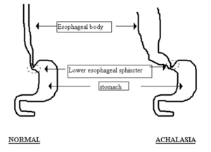 gut speak achalasia 