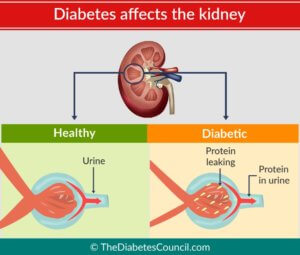 kidney