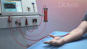 kidney dialysis 