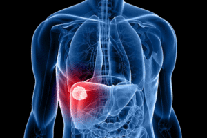 liver cancer 