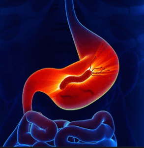 pylori 