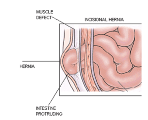 incisional hernia 