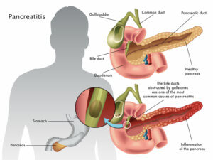 pancreatitis