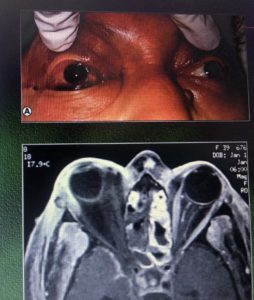 mucormycosis 